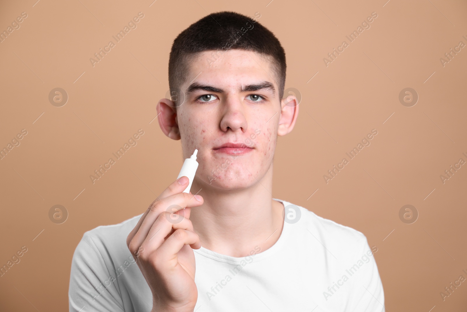 Photo of Young man with acne problem applying cosmetic product onto his skin on beige background