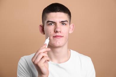 Young man with acne problem applying cosmetic product onto his skin on beige background