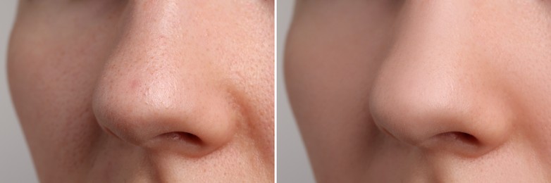 Photos of woman before and after acne treatment, closeup. Collage showing affected and healthy skin