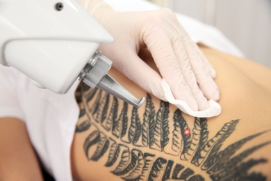 Photo of Young woman undergoing laser tattoo removal procedure, closeup
