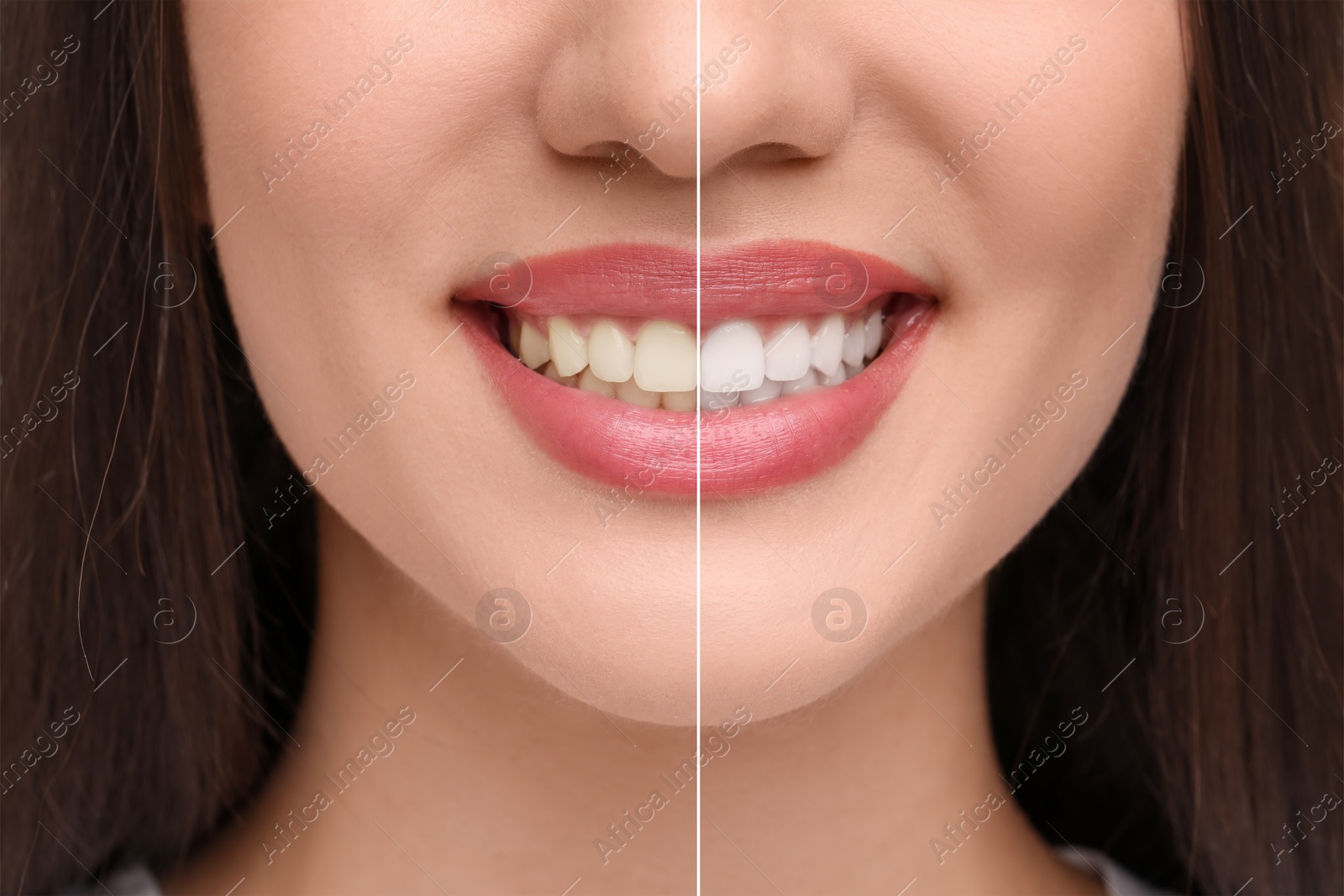 Image of Woman showing teeth before and after whitening, collage