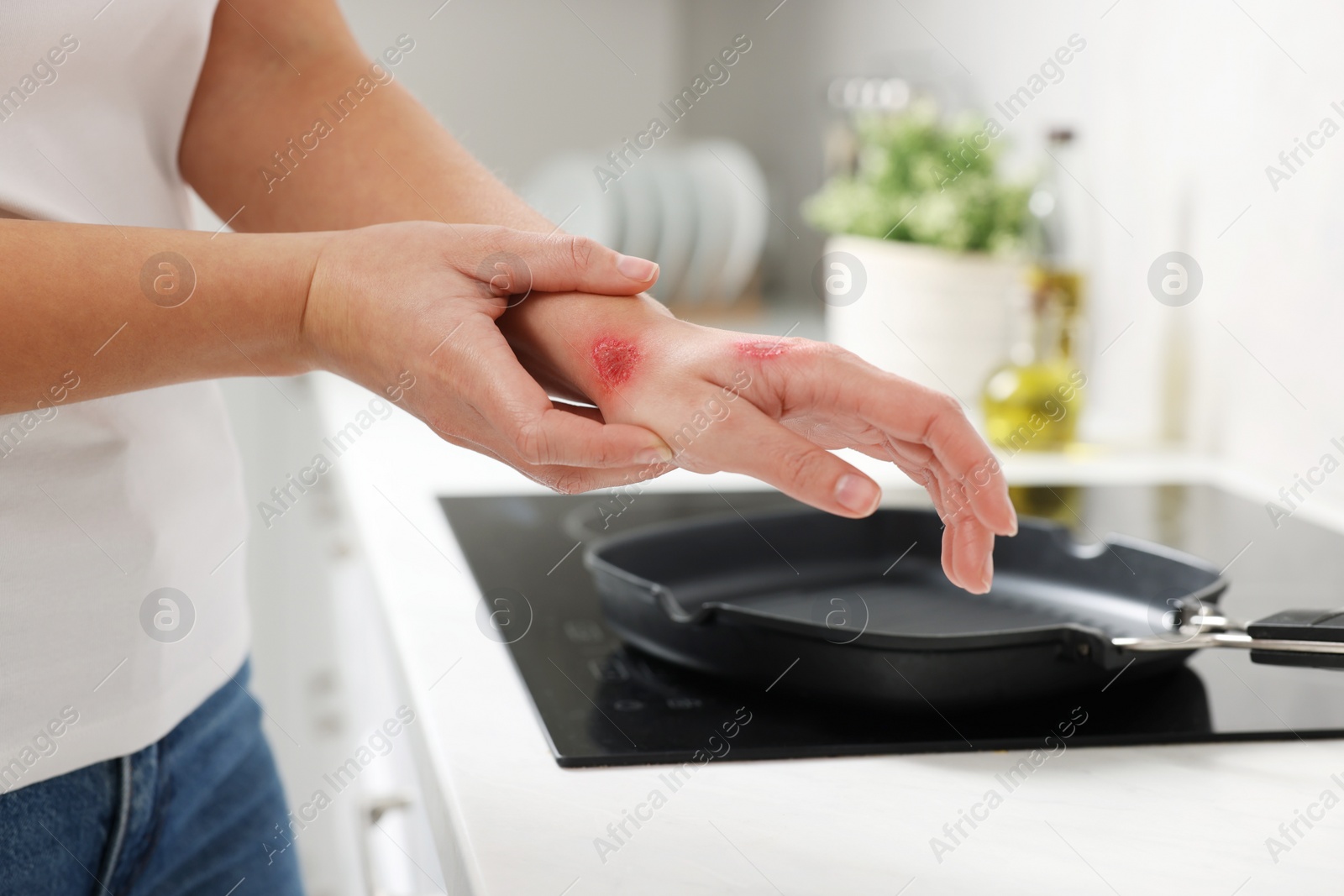 Photo of Woman with burns on her hand in kitchen, closeup