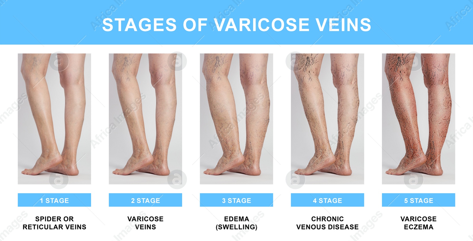 Image of Stages of varicose veins. Collage with photos of woman showing changes during different phases, closeup of legs