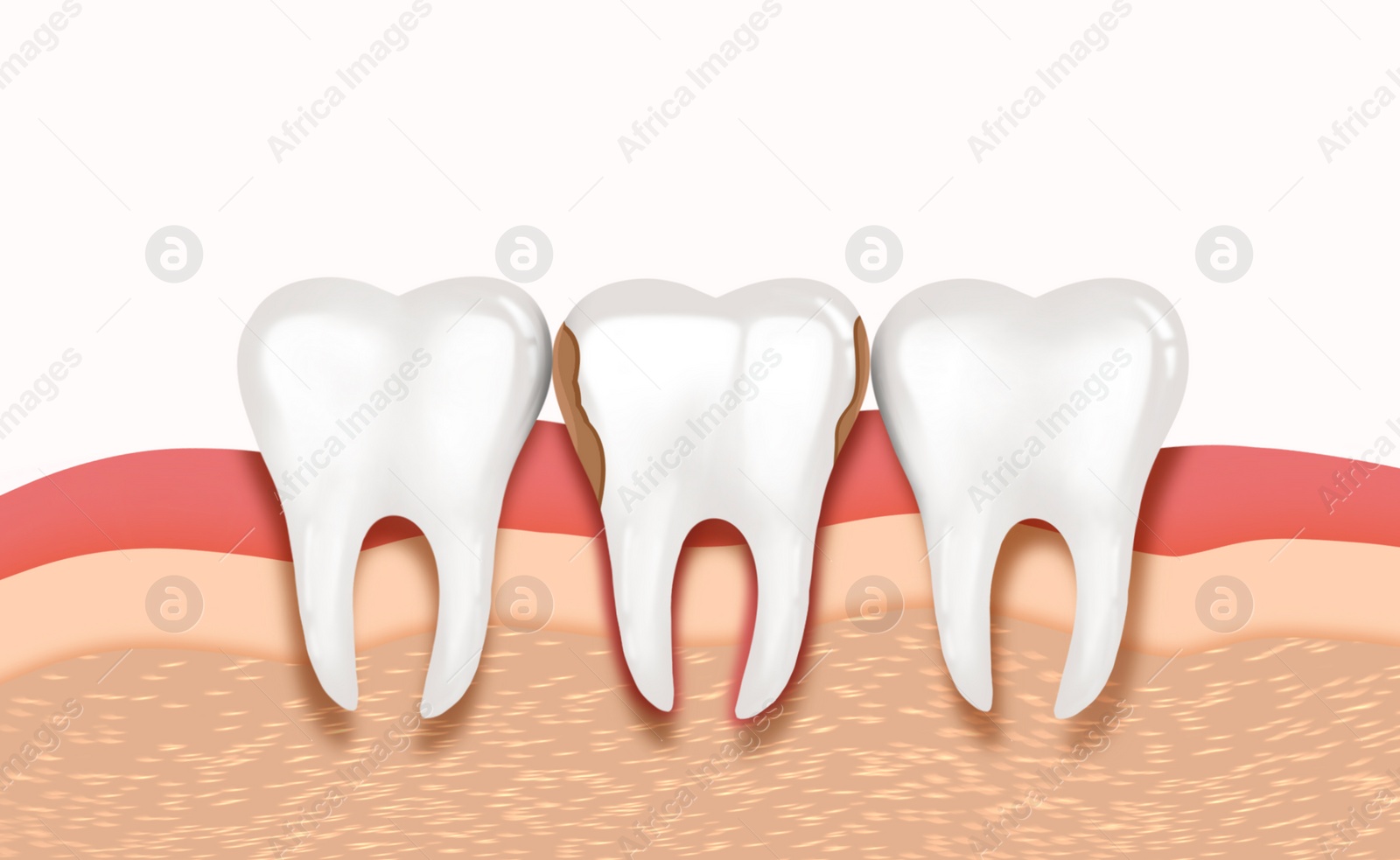 Illustration of Infected gum and tooth, illustration. Periodontal disease