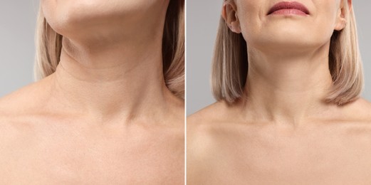 Image of Collage with photos of woman before and after cosmetic procedure on grey background, closeup