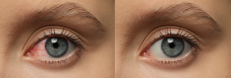 Image of Collage with photos of woman with inflamed and healthy eyes before and after treatment, closeup. Banner design