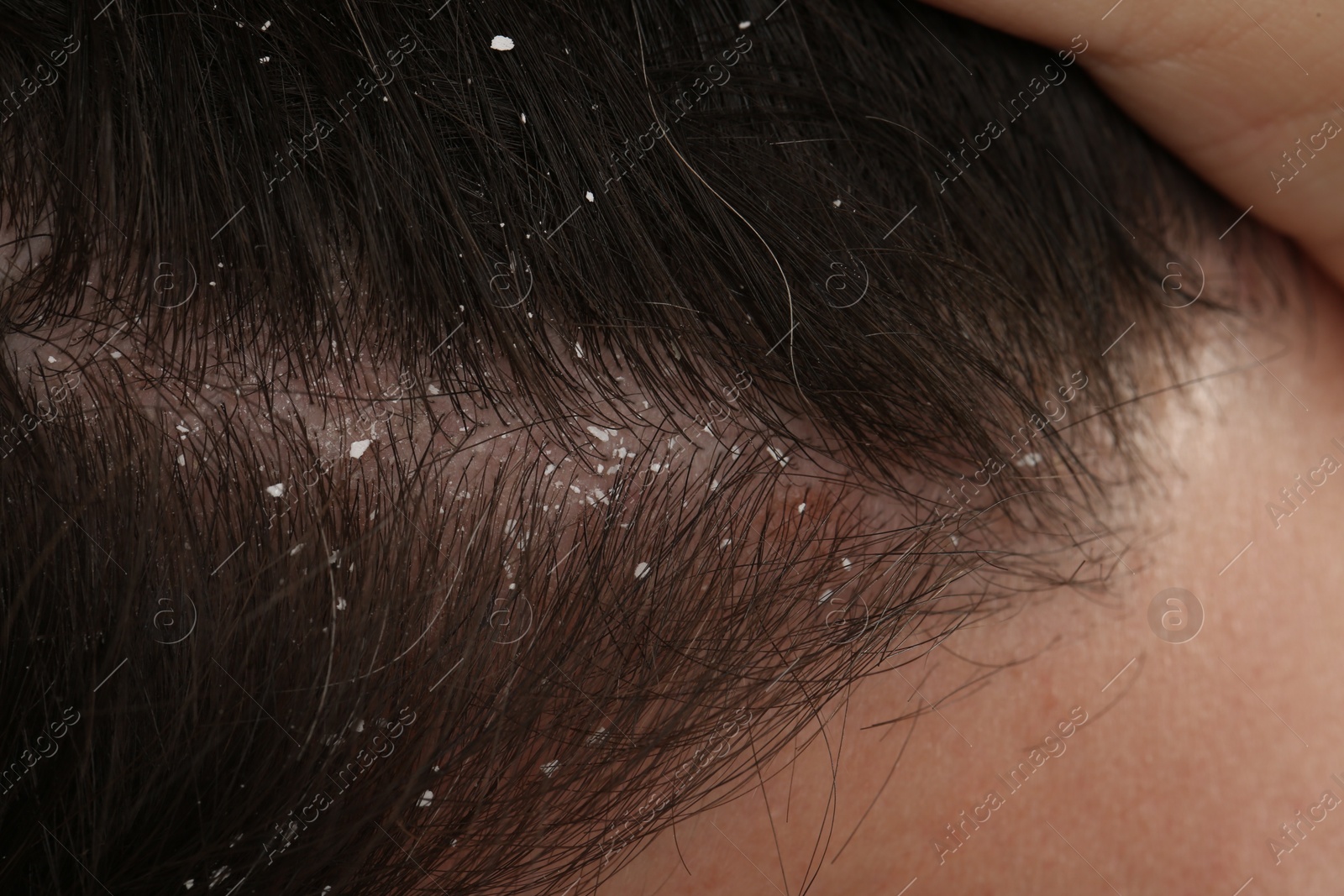 Photo of Man with dandruff in his dark hair, closeup