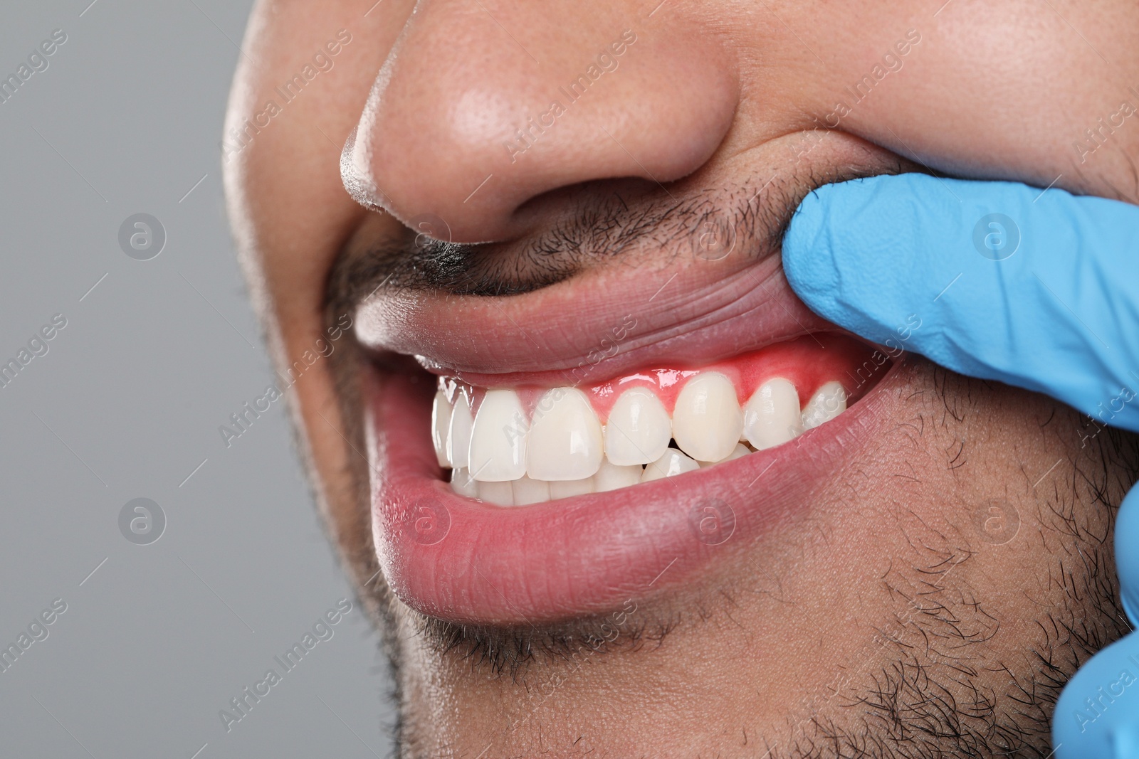Image of Doctor examining man's inflamed gum on grey background, closeup