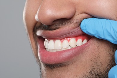 Doctor examining man's inflamed gum on grey background, closeup