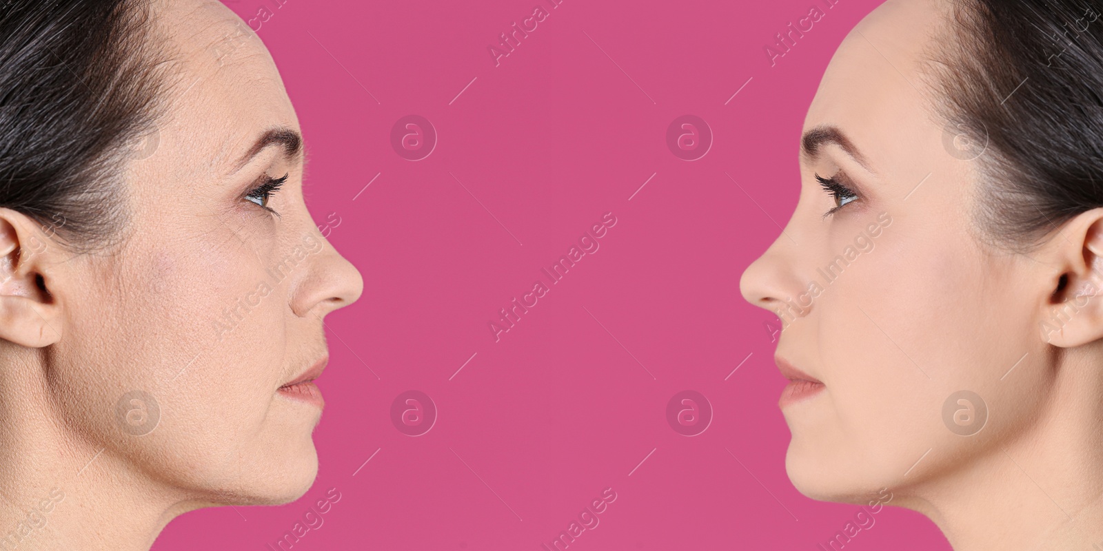 Image of Beautiful mature woman before and after cosmetic procedure on pink background, collage. Plastic surgery