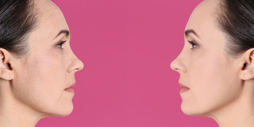 Image of Beautiful mature woman before and after cosmetic procedure on pink background, collage. Plastic surgery