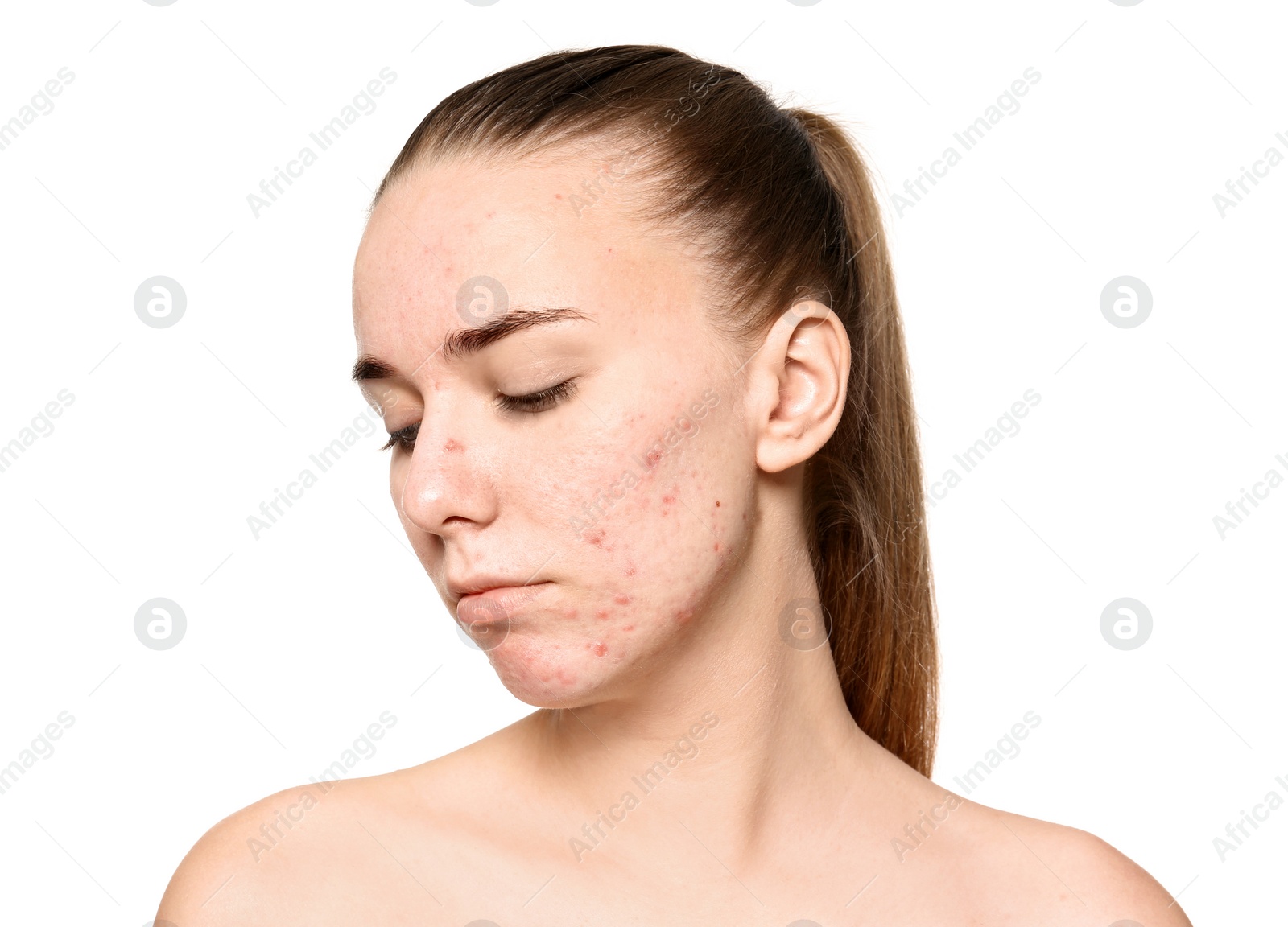 Photo of Young woman with acne problem on white background