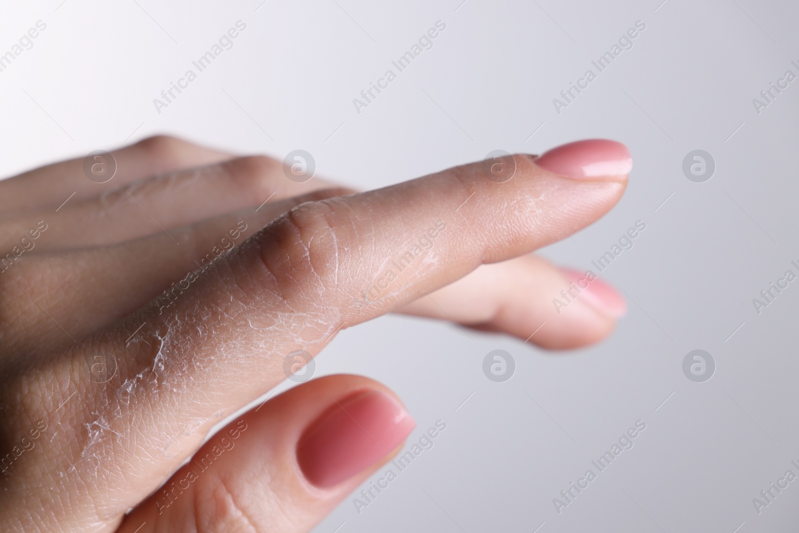 Photo of Woman with dry skin on hand against light background, macro view