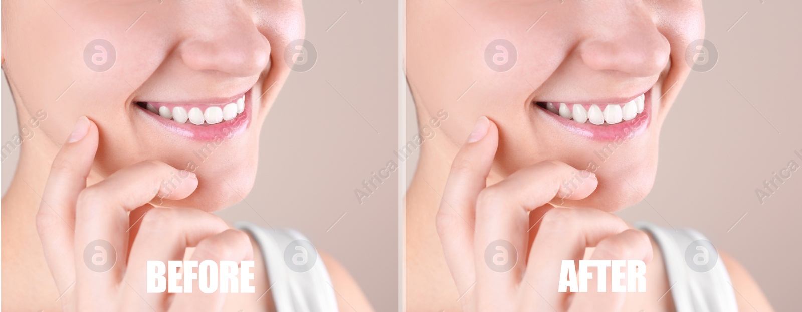 Image of Young woman before and after gingivoplasty procedure on beige background, closeup. Banner design