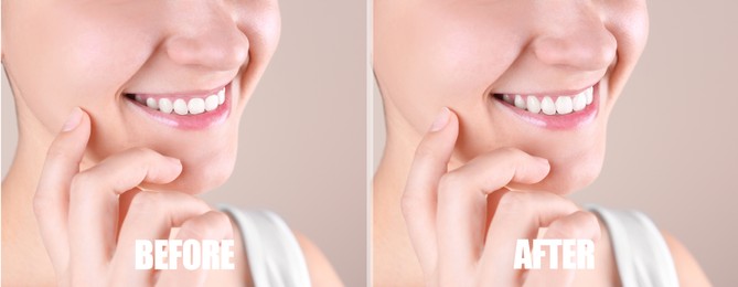 Image of Young woman before and after gingivoplasty procedure on beige background, closeup. Banner design