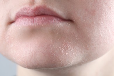 Photo of Woman with dry skin on face against light grey background, closeup