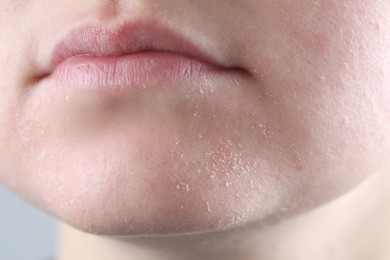 Woman with dry skin on face against light grey background, closeup