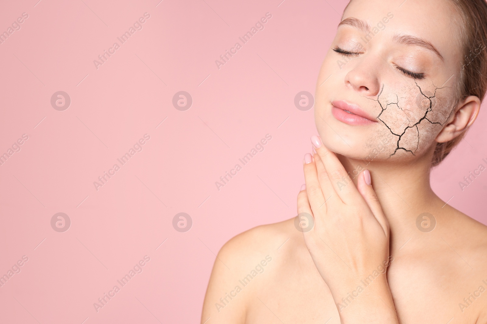 Image of Beautiful young woman with dry skin on pink background. Space for text
