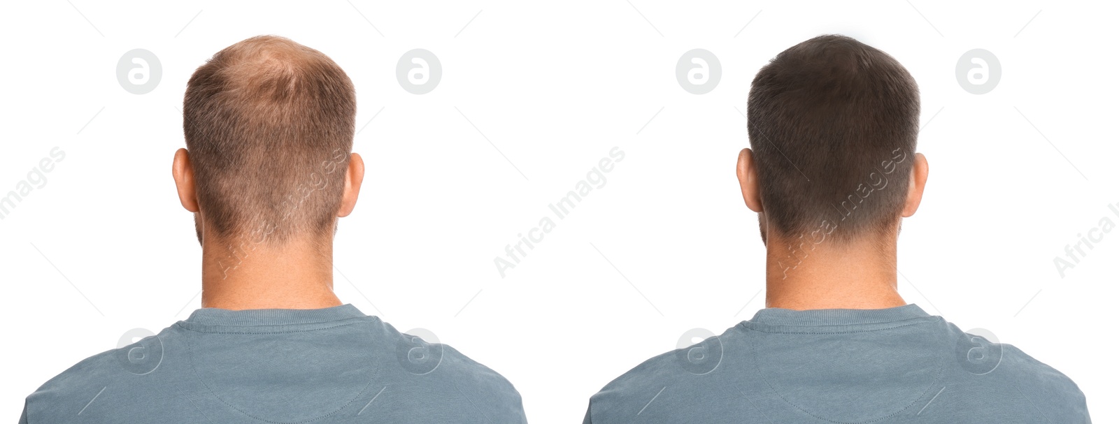 Image of Man before and after hair treatment with high frequency darsonval device on white background, back view. Collage of photos