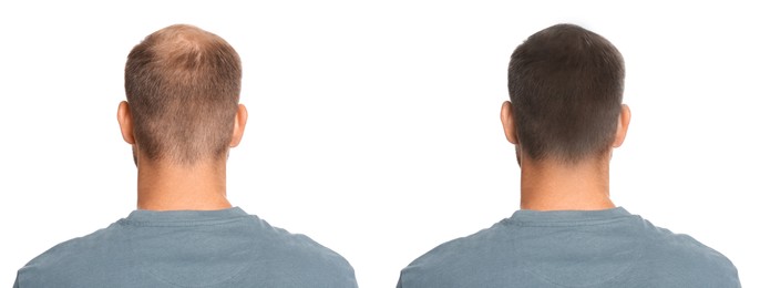 Man before and after hair treatment with high frequency darsonval device on white background, back view. Collage of photos