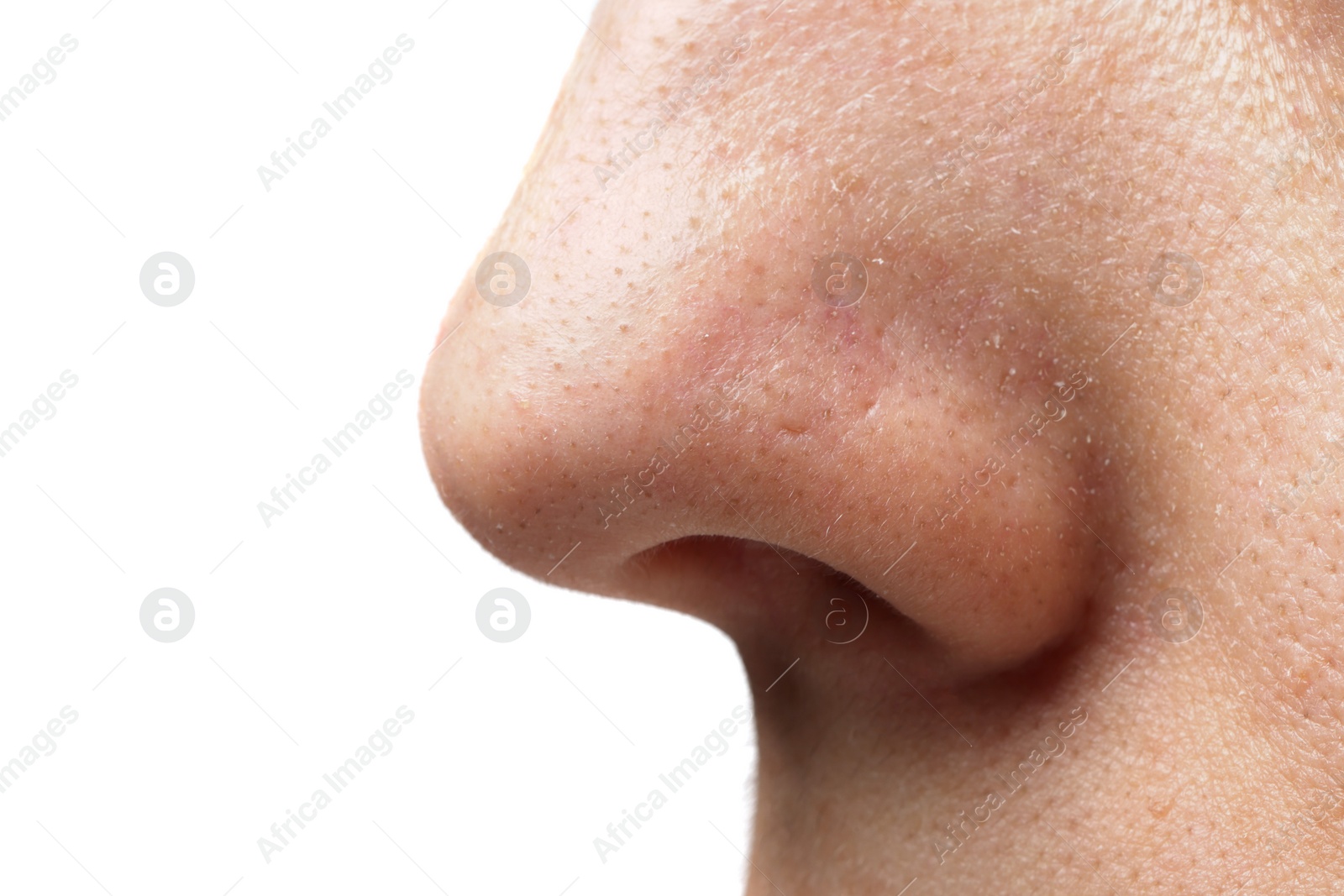 Photo of Young woman with acne problem on white background, closeup view of nose