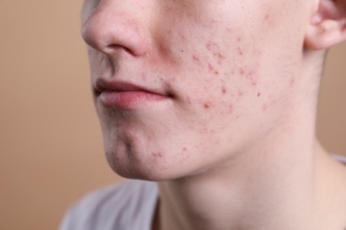 Photo of Young man with acne problem on beige background, closeup