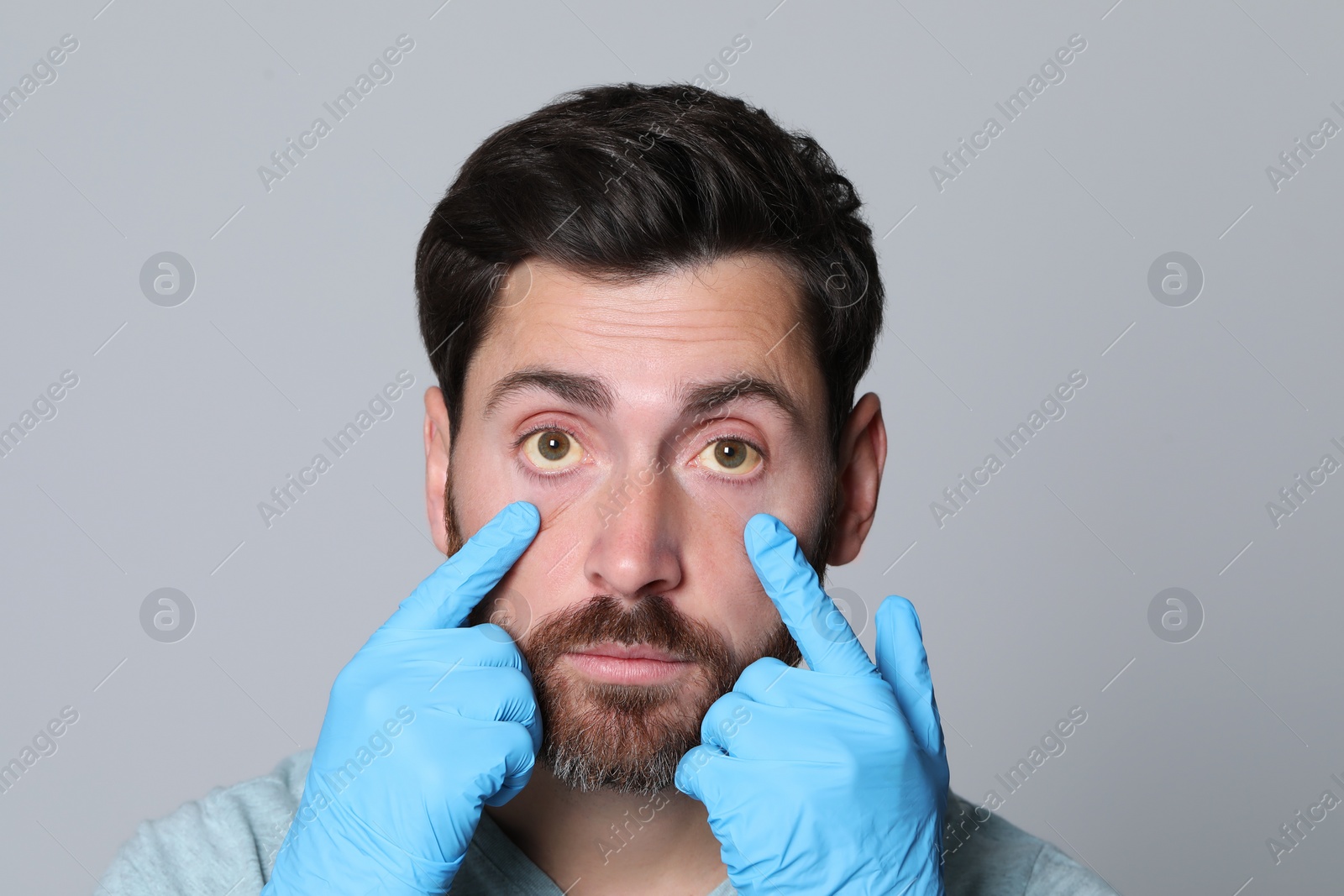 Photo of Doctor checking man with yellow eyes on grey background. Symptom of hepatitis