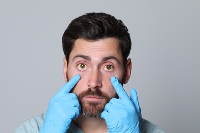 Doctor checking man with yellow eyes on grey background. Symptom of hepatitis
