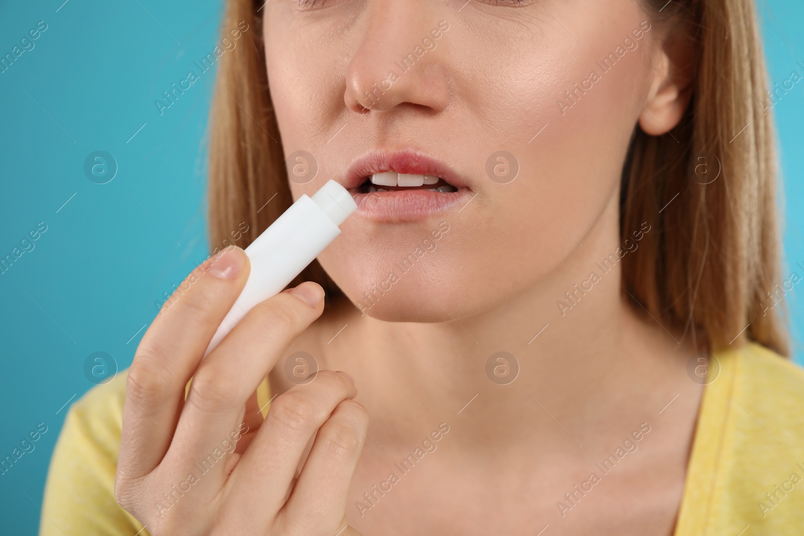 Photo of Woman with herpes applying lip balm against light blue background, closeup