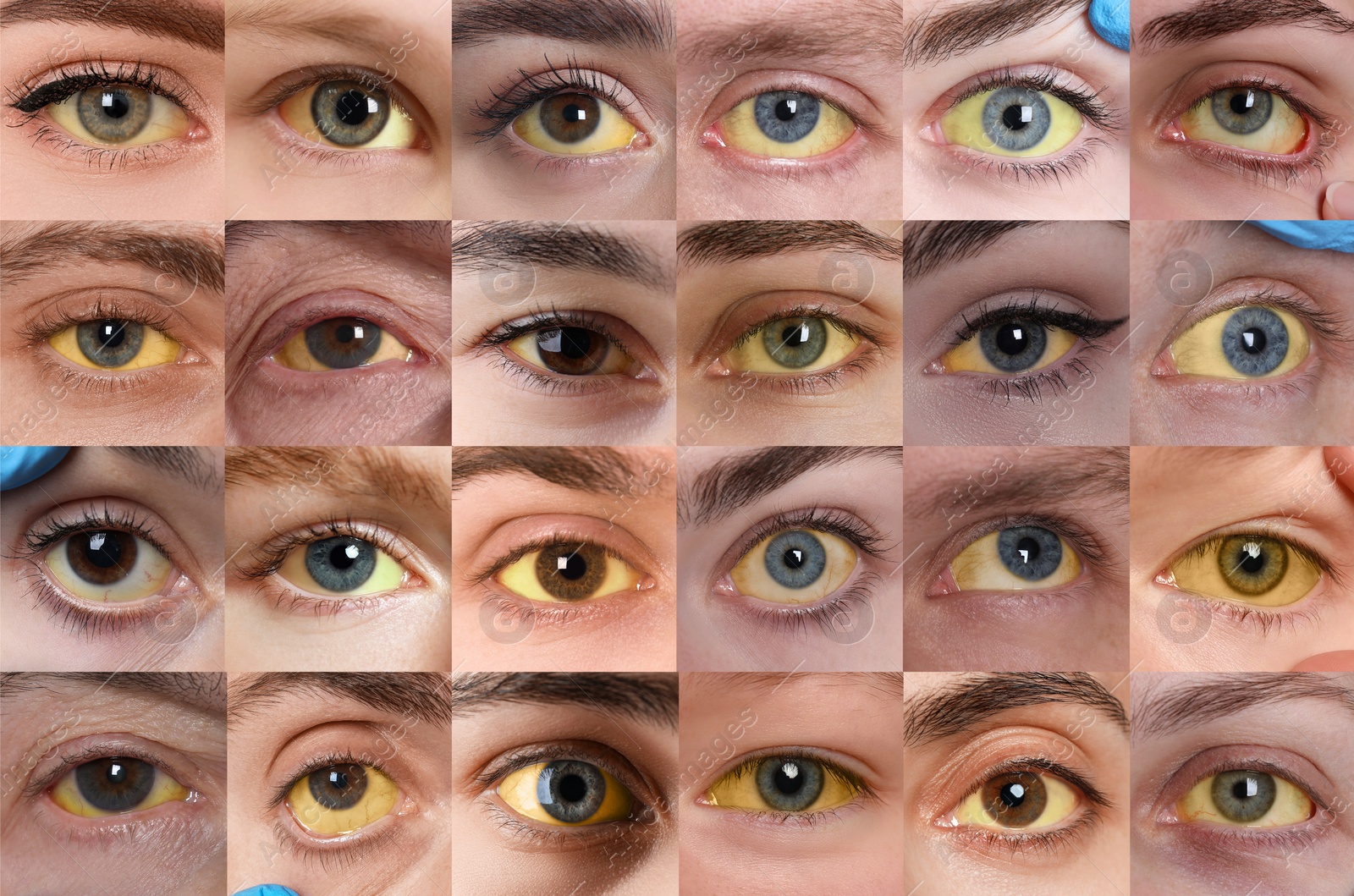 Image of Yellowing of eyes as symptom of hepatitis. Collage with photos of people