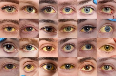 Yellowing of eyes as symptom of hepatitis. Collage with photos of people