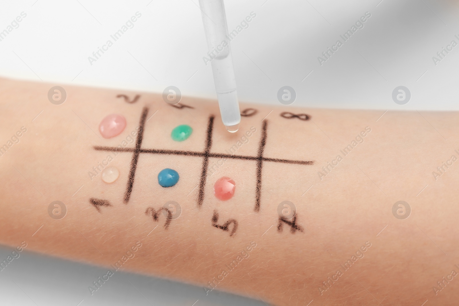 Photo of Patient undergoing skin allergy test at light table, closeup