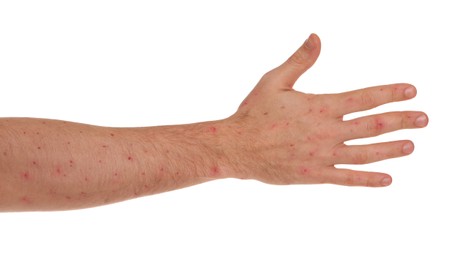 Man with rash suffering from monkeypox virus on white background, closeup