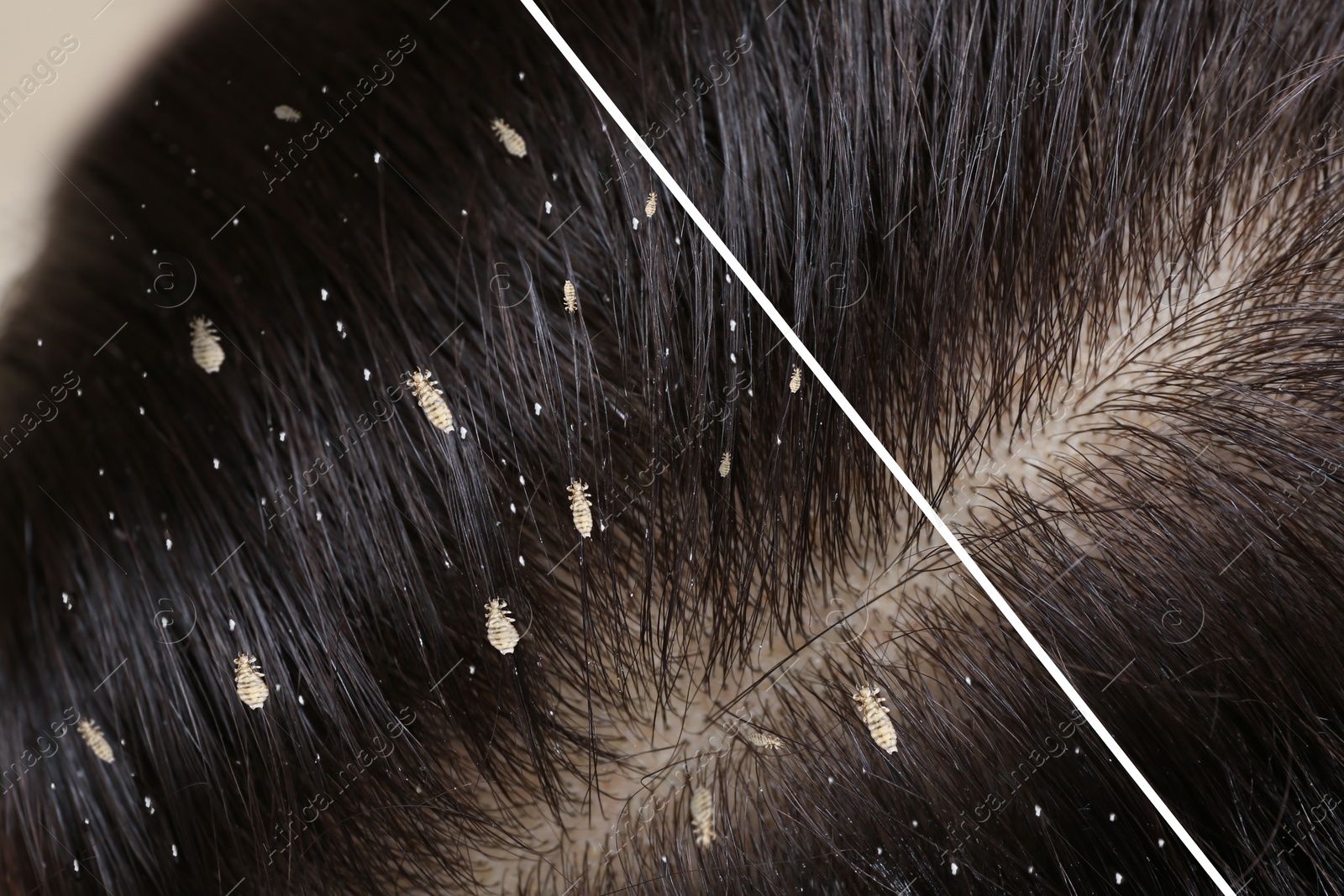 Image of Collage showing woman's hair before and after lice treatment, closeup. Suffering from pediculosis