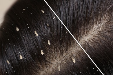 Image of Collage showing woman's hair before and after lice treatment, closeup. Suffering from pediculosis