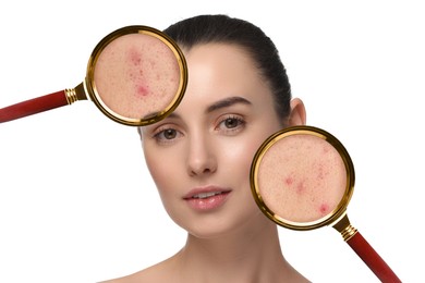 Dermatology. Woman with skin problem on white background. View through magnifying glasses on acne