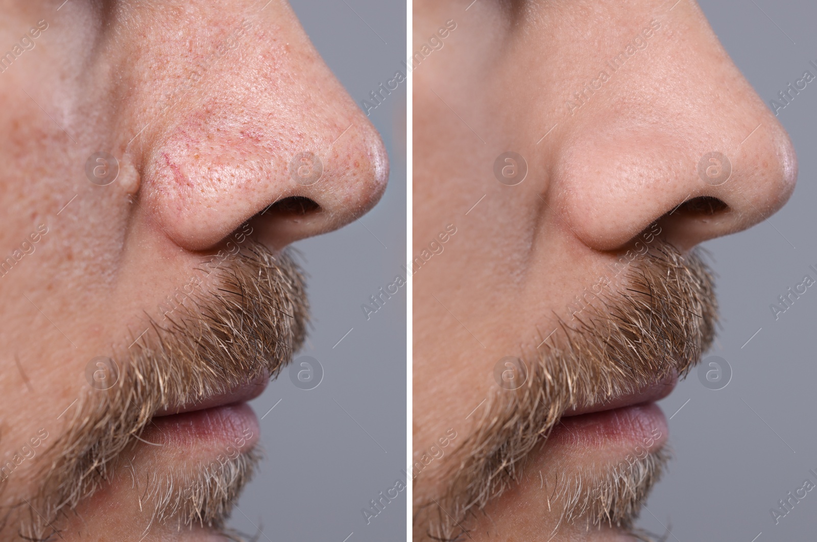 Image of Blackhead treatment, before and after. Collage with photos of man on grey background, closeup view