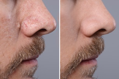 Blackhead treatment, before and after. Collage with photos of man on grey background, closeup view