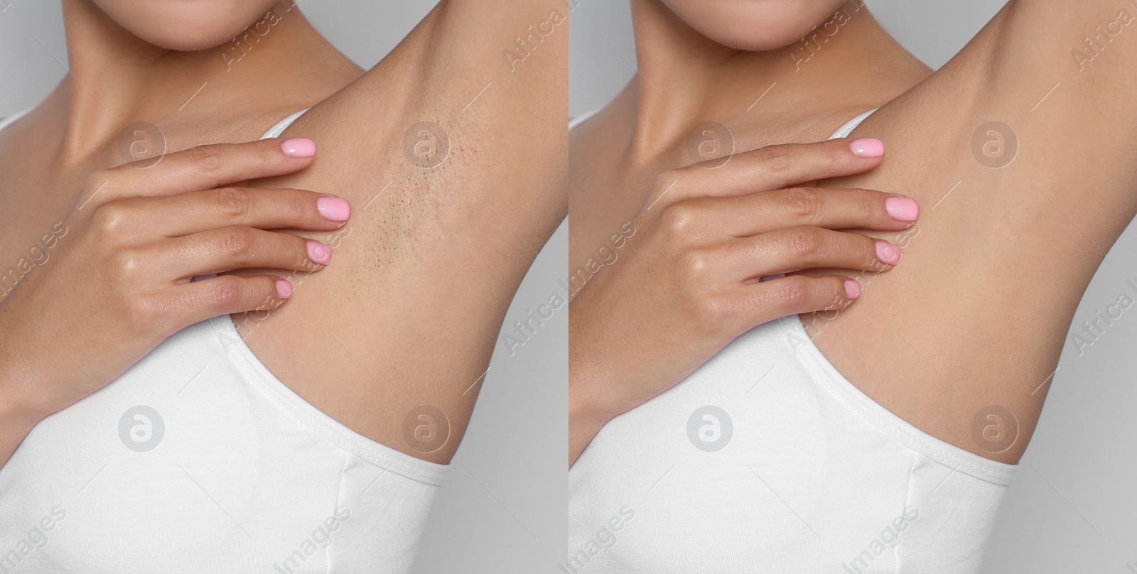 Image of Before and after epilation. Collage with photos of woman showing armpit on light background, closeup