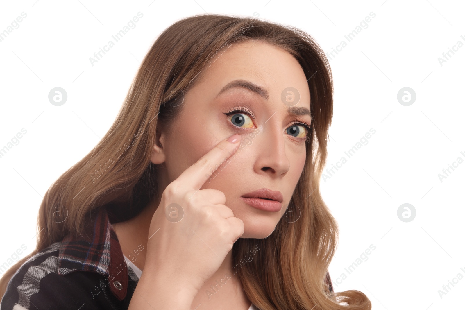 Photo of Woman with yellow eyes on white background. Liver problems symptom