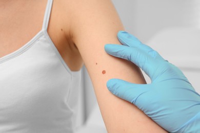 Dermatologist in rubber glove examining patient's birthmark on blurred background, closeup