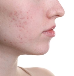 Photo of Young woman with acne problem on white background, closeup