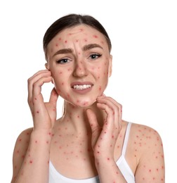 Image of Woman with rash suffering from monkeypox virus on white background