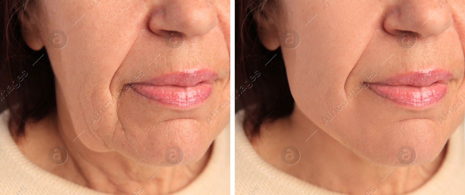 Image of Mature woman before and after skin tightening treatments. Collage with photos, closeup