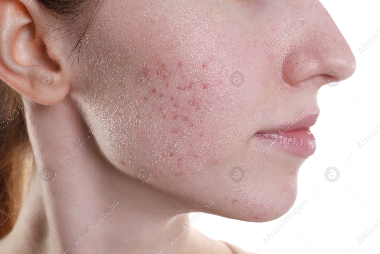 Photo of Young woman with acne problem on white background, closeup