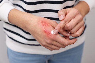 Photo of Woman applying healing cream onto burned hand, closeup