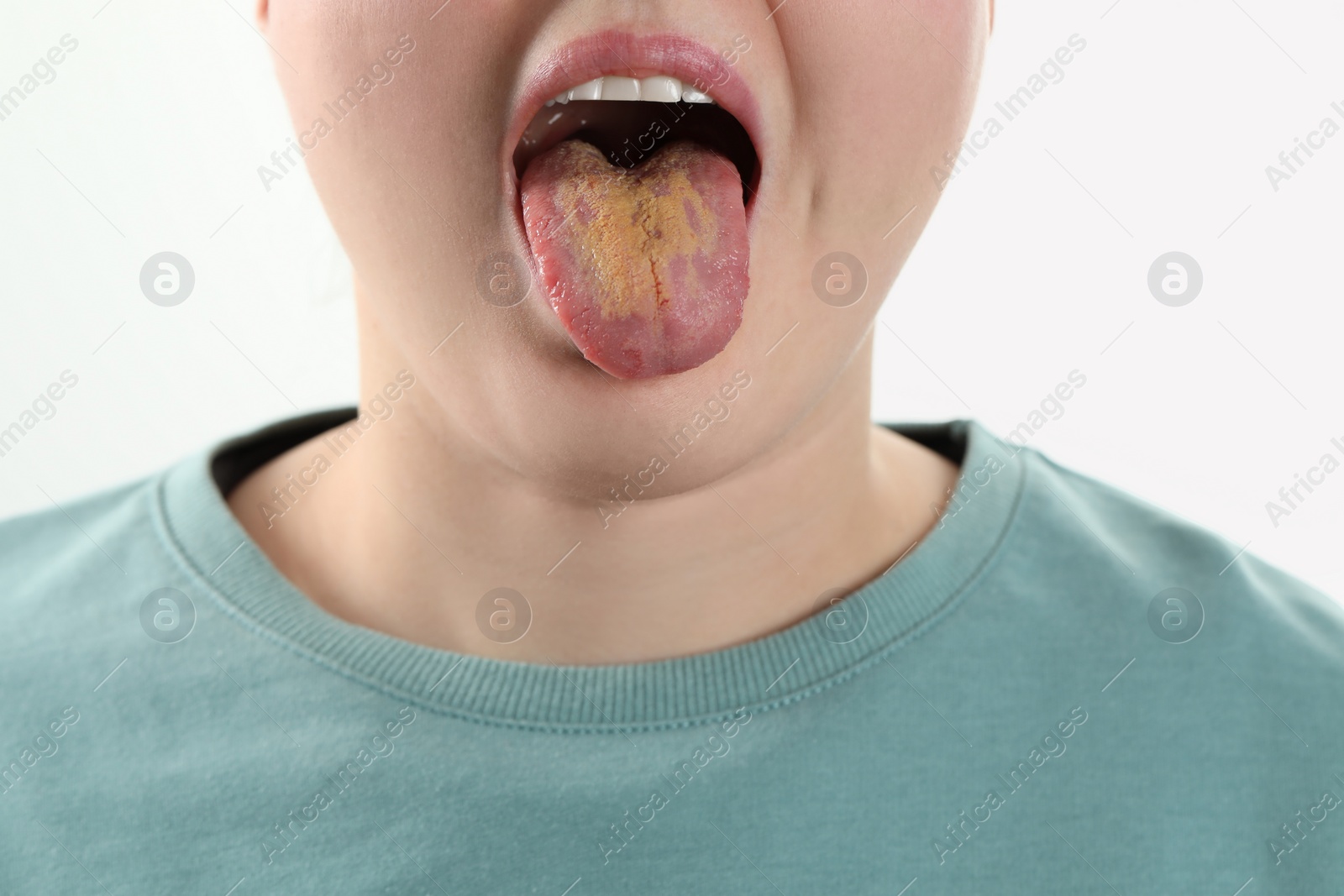 Photo of Gastrointestinal diseases. Woman showing her yellow tongue on white background, closeup
