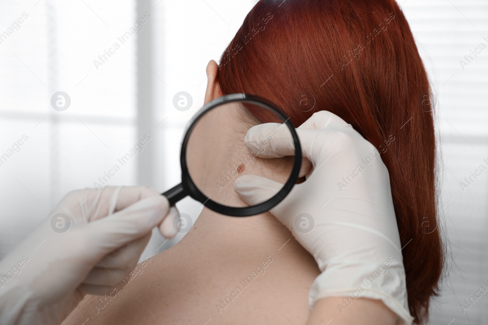 Photo of Dermatologist examining patient's birthmark with magnifying glass in clinic, closeup view