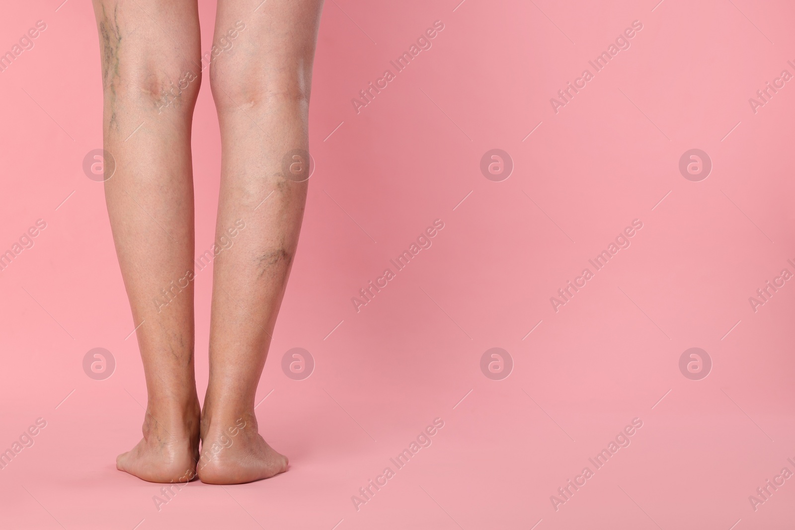 Photo of Closeup view of woman with varicose veins on pink background. Space for text