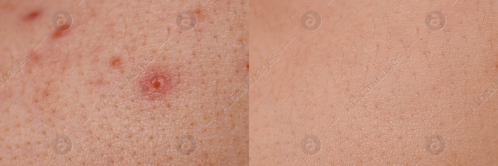 Image of Collage with photos of person suffering from acne before and after treatment, closeup. Banner design showing affected and healthy skin